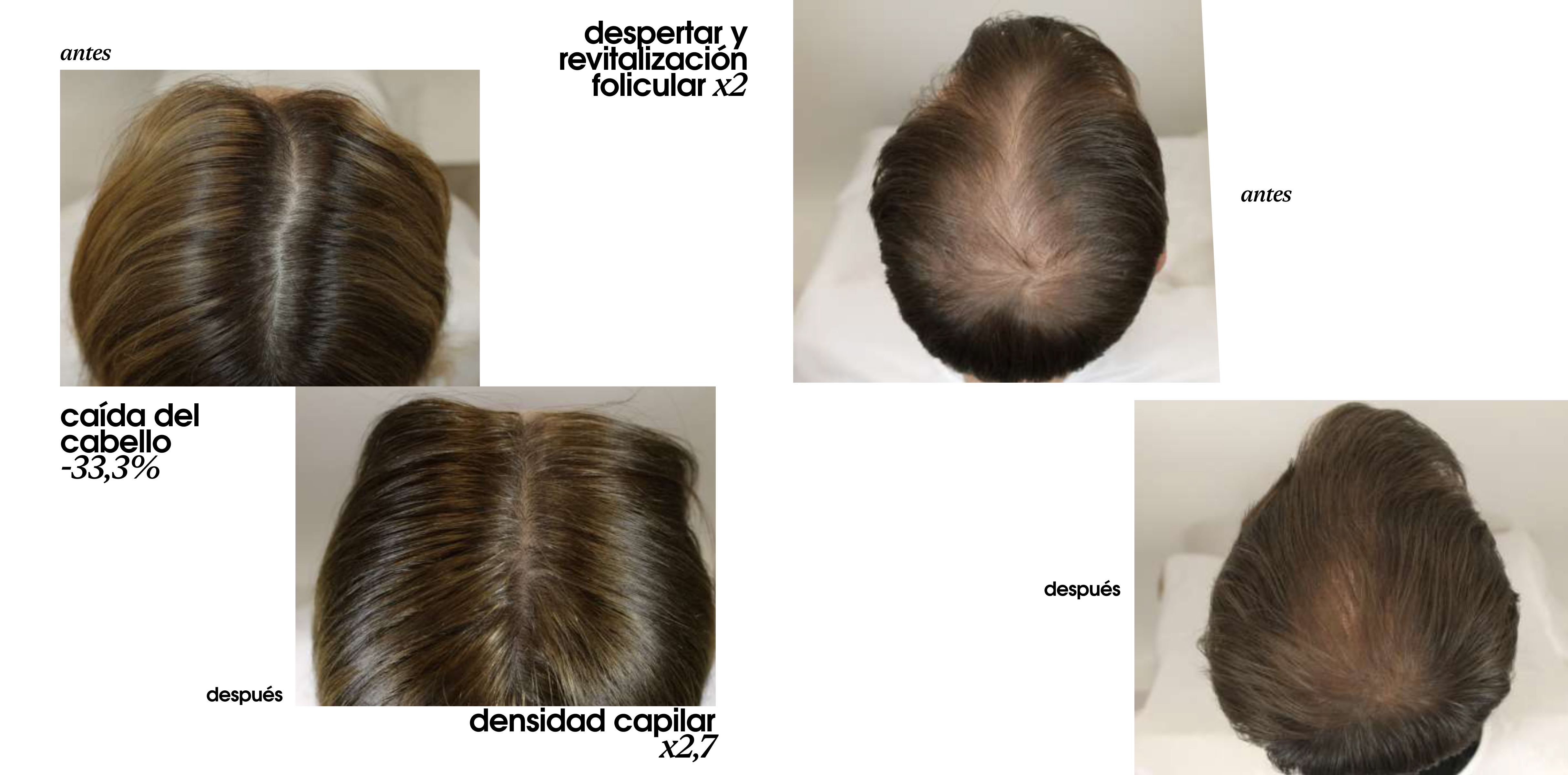 Before and after 84 days using Extreme Caviar Revitalizing ExosomicShot Scalp Concentrate